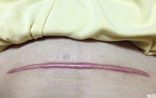 3 剖宫产后的注意事项 剖腹产的产妇,自我恢复会比较的慢,因此有一些