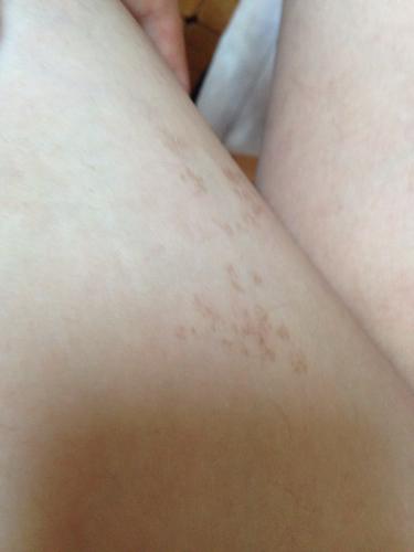 大腿上这是什么斑.有了好多年了.后背也有一大块.不是胎记.是汗斑吗.