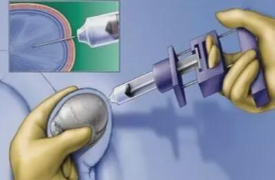 这是睾丸活检术的一种,主要针对无精子症的患者,既是是一种诊断,又是