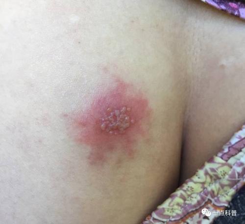 有的医生把发生在臀部以及外阴部位的单纯疱疹都称之为生殖器疱疹