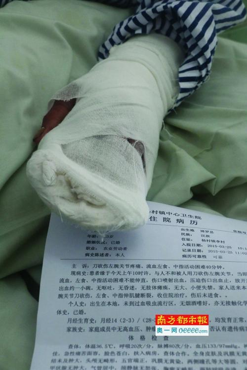 哥哥家为拓路砍弟弟树 争执中嫂子刀断弟媳手指肌腱