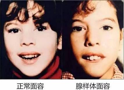 【腺样体面容对比事例】