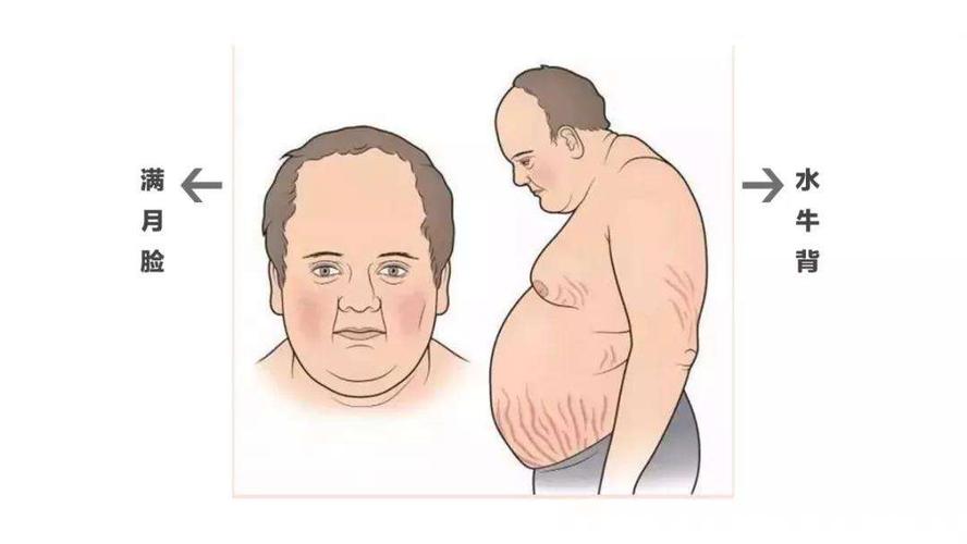 满月脸水牛背的图片,满月脸是什么病导致的?