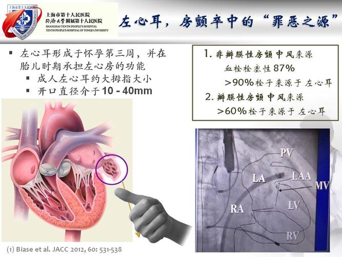 左心耳封堵术后抗凝:经验与证据