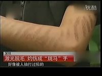 视频: 深圳女子激光脱毛 灼伤成"斑马"手[高清版]-视频 直击