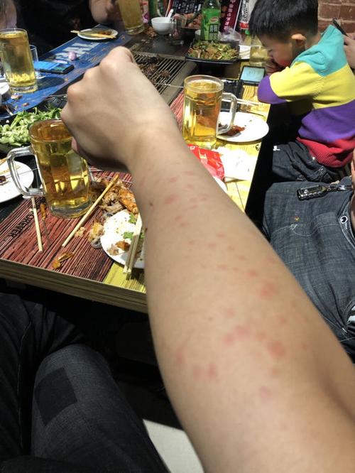 为什么喝酒后两个小手臂上出现红斑?