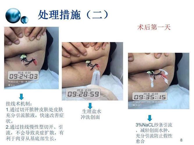 【ppt】一例肛周脓肿术后切口护理