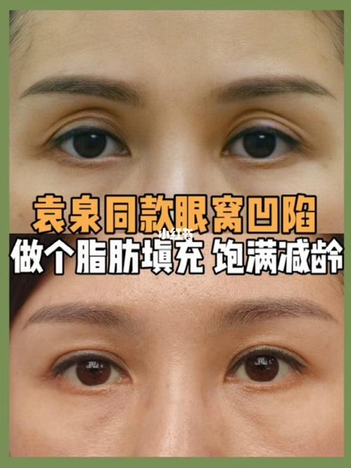 袁泉同款眼窝凹陷,脂肪填充是智商税?