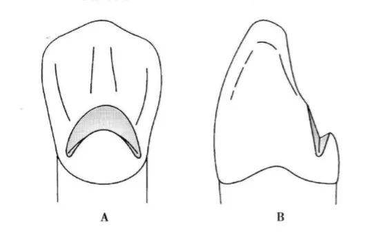 沿牙体长轴放置金刚砂球钻,然后将角度稍稍朝向牙体中心 ; 舌隆突的