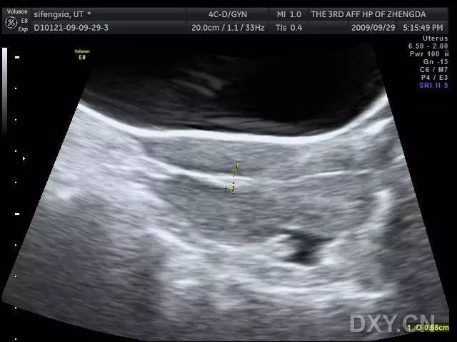 子宫穿孔的超声诊断