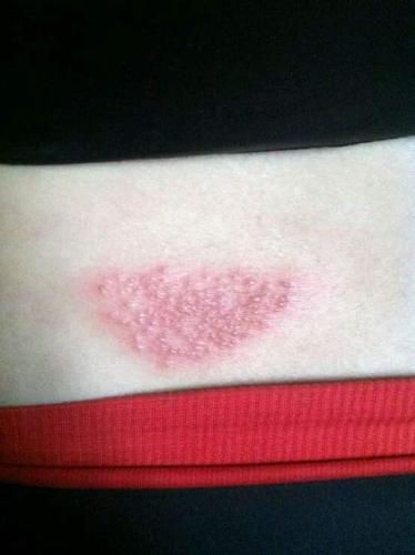 什么是"蛇盘疮",蛇盘疮疼痛难忍,该如何缓解?