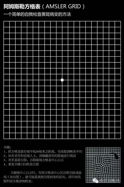 视力的隐形杀手——老年性黄斑变性!