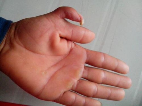 我手上有个六指可以做手术吗?