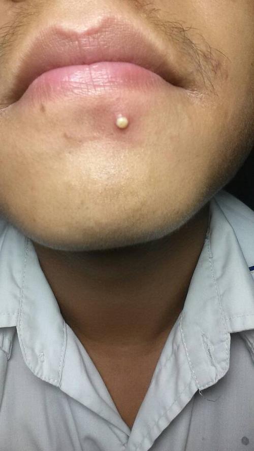 这个痘痘挤不出来,是不是没熟,是挤出来好还是让他自然掉