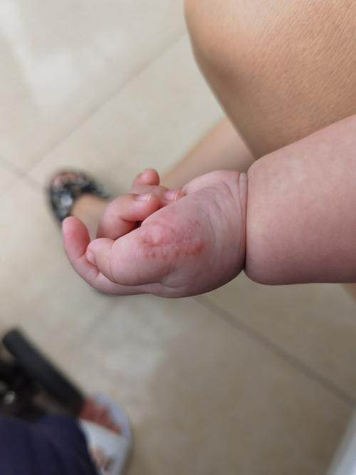 听说都是天使宝宝98多指手术 六指宝宝_祛疤_多指_母婴_育儿经验