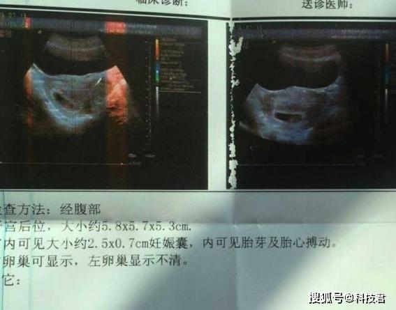 7,网上说的孕囊形状特别长,倍数相差很大,是怀男宝的症状.