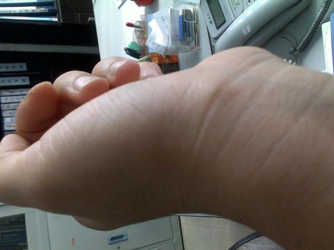 最近手腕上,太渊和大陵穴之间长了个包,不知道怎么回事