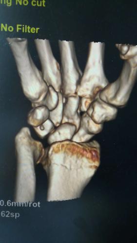 中医院外二科中医手法复位也是这么牛