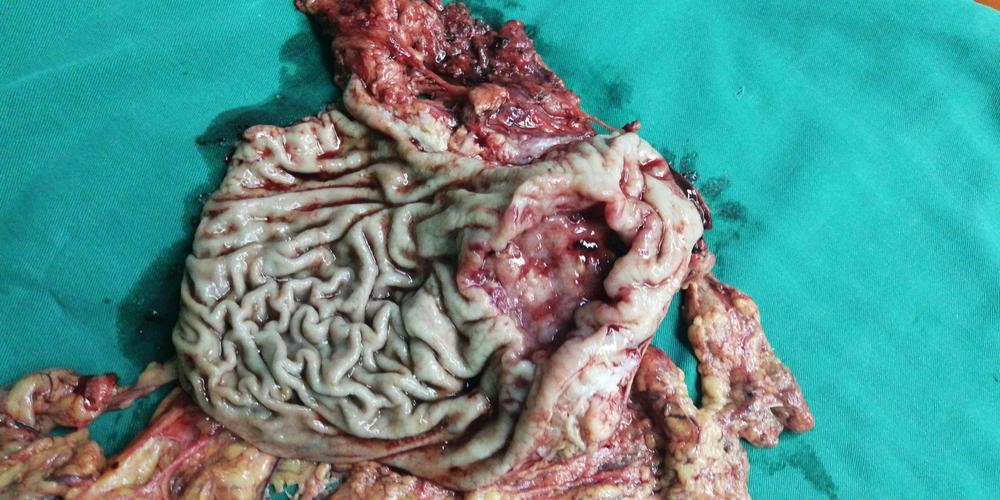 一例局部晚期胃癌转化成功,并成功实施手术的报道!