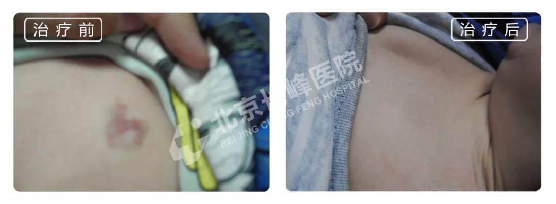 所有血管瘤患者 连线专家,在线问答,这些问题你遇到过吗?