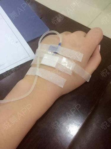 因为我的鼻子是做的膨体,所以术后5天都需要输头孢~这是我在医院输液