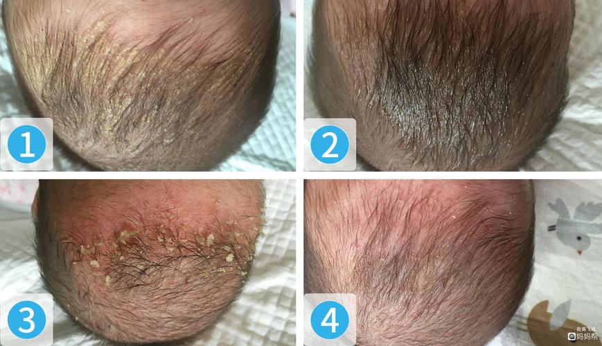 宝宝头垢多,千万别动手抠