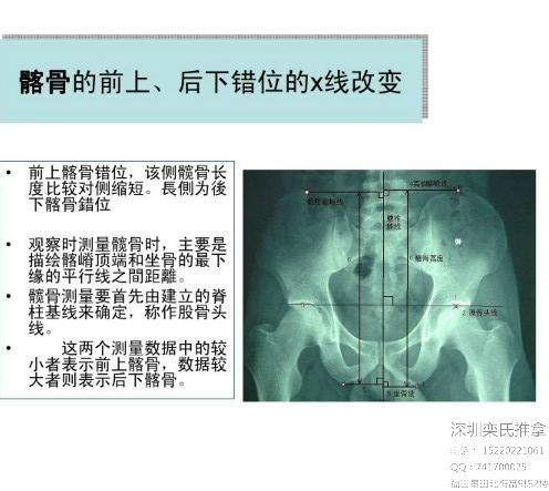 骶髂关节错位临床分析