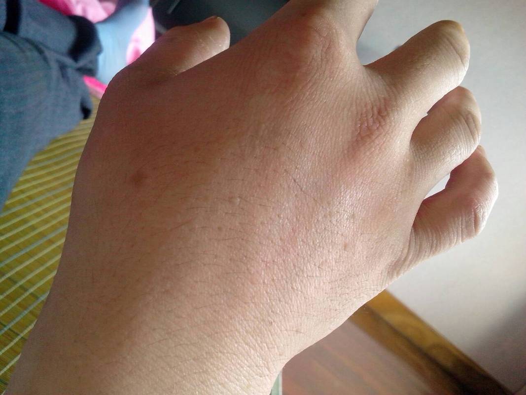 问:我两只手背上有许多小疼瘩是怎么病怎么办?