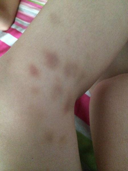 身上总是莫名其妙出现一些青紫色或青色的淤青,不知道