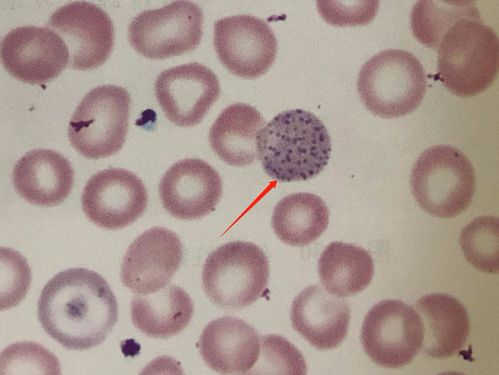 第三十二期形态学培训答案解析 写美篇  第二题   嗜碱性点彩红细胞