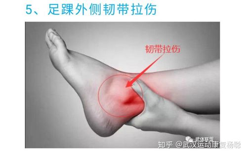 其实你这么大的一个,也有可能与你的跟腱有关,建议找专业的运动康复师