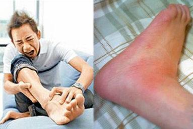痛风发作要制动,及时去医院就诊