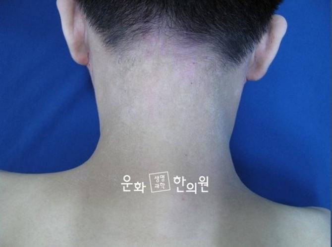 后脖子异位性皮炎治疗·异位性皮炎剥落?