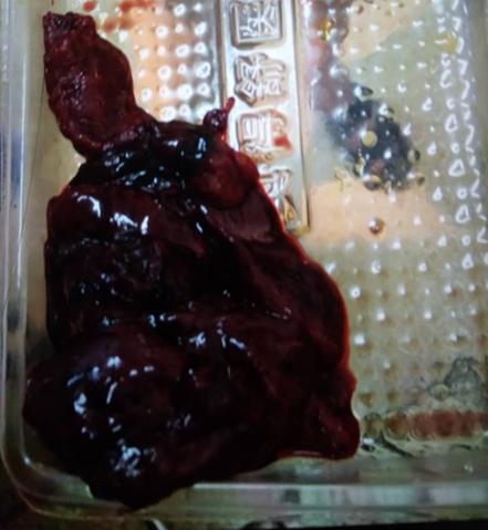 不要让肌瘤破坏七夕!子宫肌瘤