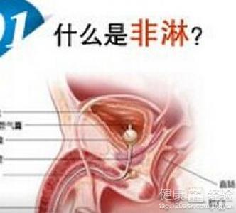 支原体非淋性尿道炎是怎么回事
