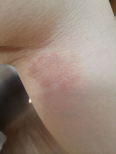 膝窝处长了块东西,不知道是不是皮癣还是什么,请帮忙看一看(附图)