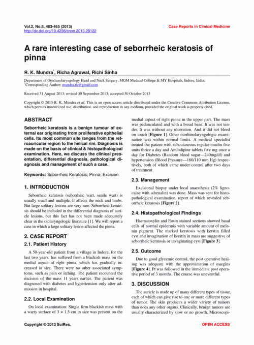 期刊a rare interesting case of seborrheic keratosis of pinna