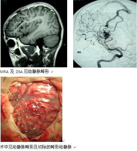 脑动静脉畸形的显微外科手术治疗