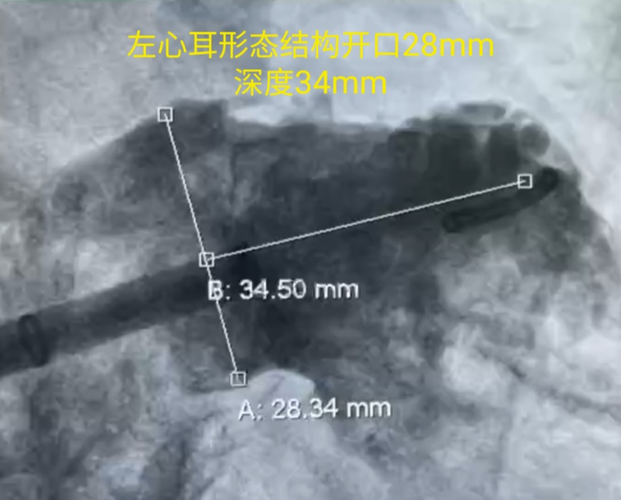 61西安市第三医院心内科成功开展房颤射频消融左心耳封堵一站式手术