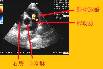 能向肺动脉内射血的血管应来自左心,这应该是冠状动脉的一个营养肺