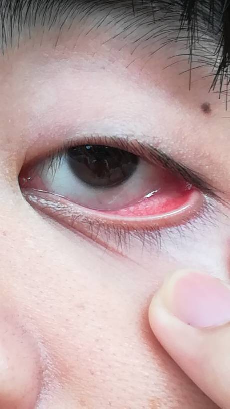 眼睛有血丝有异物感啊怎么办?