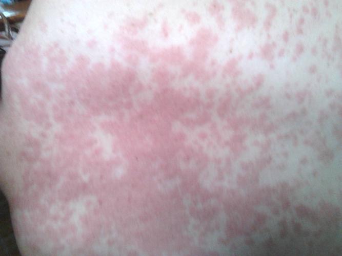 过敏性皮炎的发病原因比较复杂,是患者自身的体质以及各种外部原因相