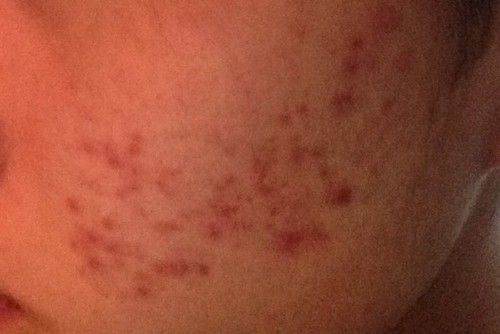 这是痘印还是痘痘呢 这种情况怎么治疗啊