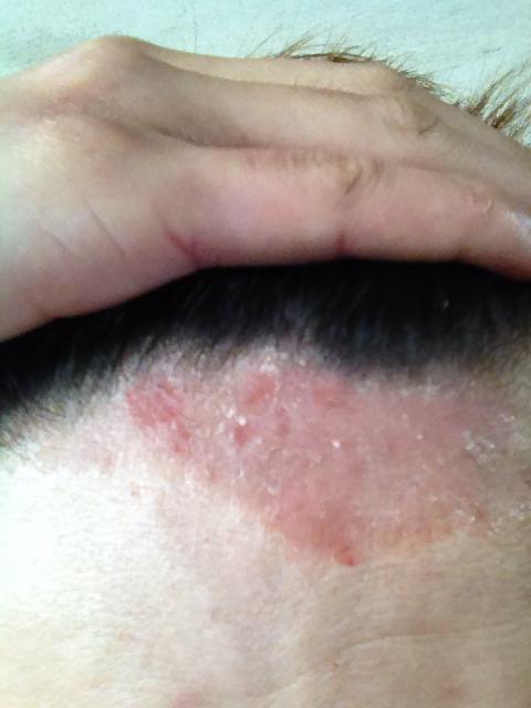 额头前的一块红斑,每次一长像头皮屑一样的东西就痒,就会挠,这是什么