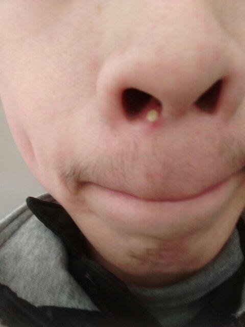 我鼻子里最近长了个白泡,一碰就痛,请问是怎么回事