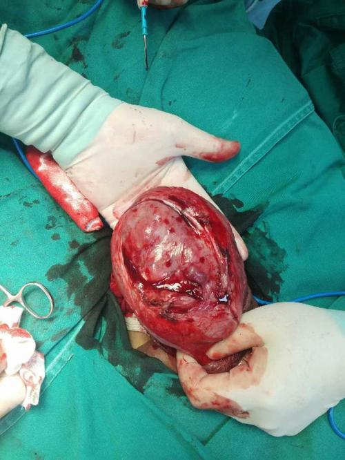 我院泌尿外科完成首例巨大睾丸肿瘤完整切除术