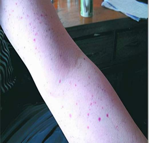 手臂或皮肤总有淤青是怎么一回事?会不会是白血病?