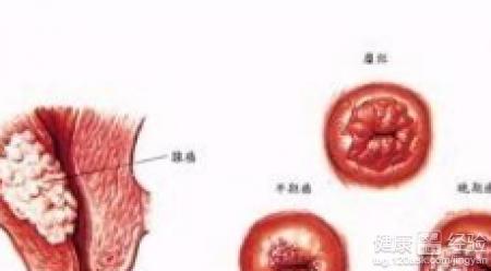 概 述 宫颈囊肿也称为子宫颈腺滞留囊肿.