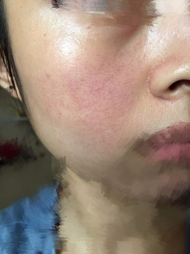 脸上是什么问题 ,毛周角化还是什么
