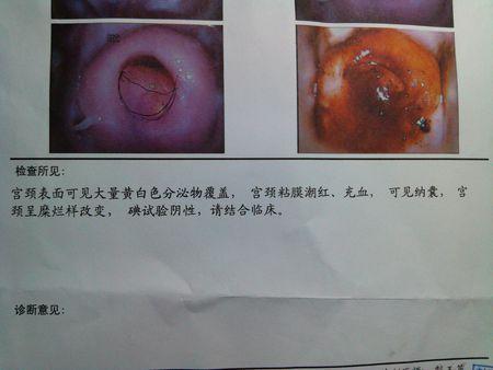 盆腔积液怎么办